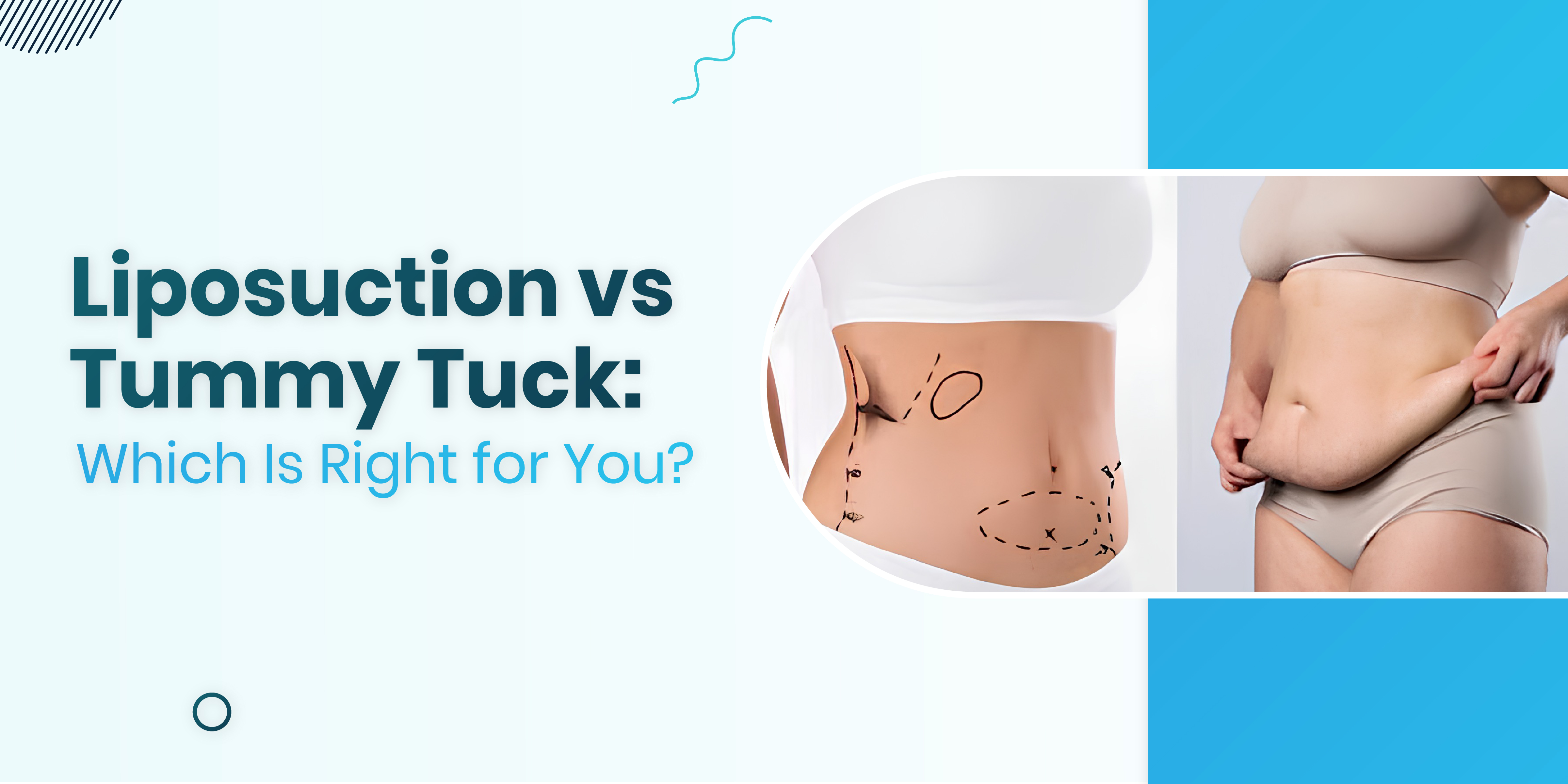 Liposuction vs Tummy Tuck: Which Is Right for You?